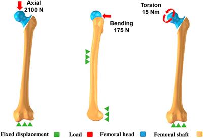 Biomechanical evaluation of three implants for treating unstable femoral intertrochanteric fractures: finite element analysis in axial, bending and torsion loads